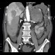 Neuroendocrine tumour of adrenal gland, liver metastasis, necrotic: CT - Computed tomography